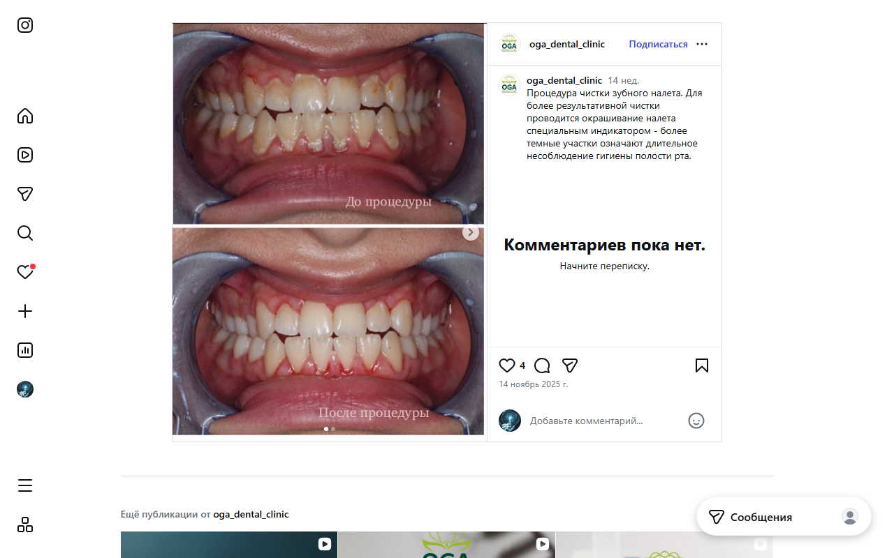 Профессиональная чистка зубов